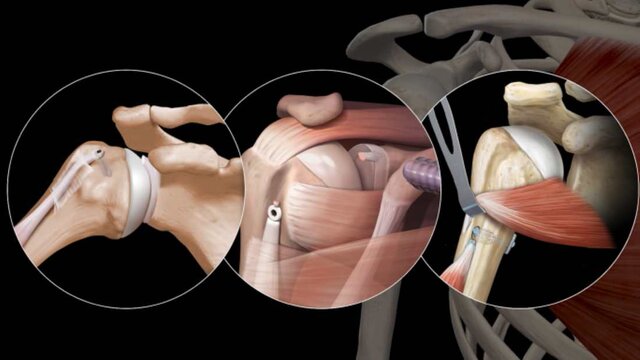 Biceps Tendinitis: Treatment Options, video thumbnail