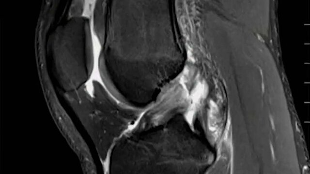 ACL Tears: Treatment Options, video thumbnail