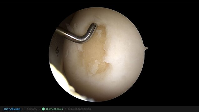 Knee Cartilage Defects: Biomechanics of the Knee With Osteochondral Lesions, video thumbnail