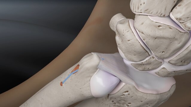 TFCC Tears: Ulnar Tunnel Foveal Repair, video thumbnail