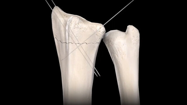 Wrist Fractures: Treatment Options, video thumbnail
