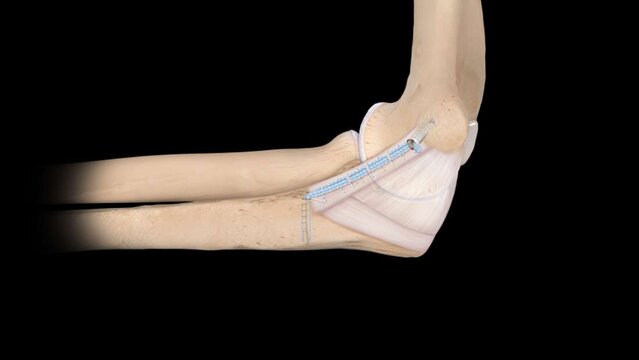 UCL Injuries (Tommy John): Treatment Options, video thumbnail