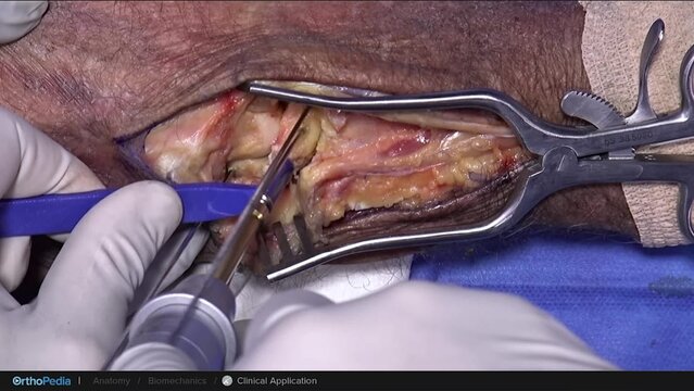 Scapholunate Ligament Injuries: All-Dorsal InternalBrace Ligament Augmentation Procedure, video thumbnail