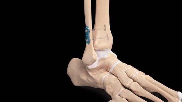 High Ankle Sprains (Syndesmotic Injuries): Syndesmosis Repair Using Suture Implant, video thumbnail