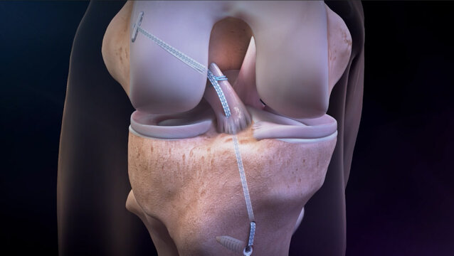 ACL Tears: ACL Repair Using a Suture Implant, video thumbnail