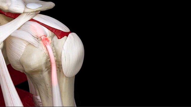 Biceps Tendinitis: Overview, video thumbnail