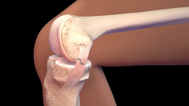 MCL and LCL Tears: Treatment Options, video thumbnail