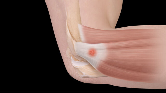 Tennis Elbow (Lateral Epicondylitis): Treatment Options, video thumbnail
