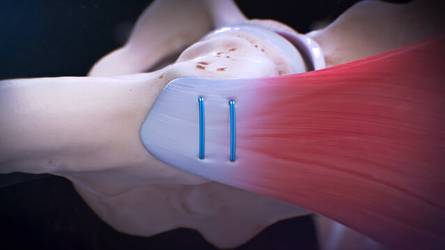 Gluteus Medius Tears: Repair of a Partial-Thickness Gluteus Medius Tear With Anchors, video thumbnail