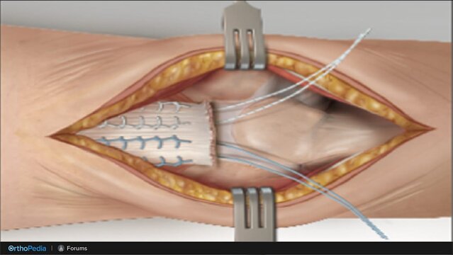 Distal Triceps Tendon Tears: Triceps Tendon Repairs for Triceps Tendon Ruptures, video thumbnail