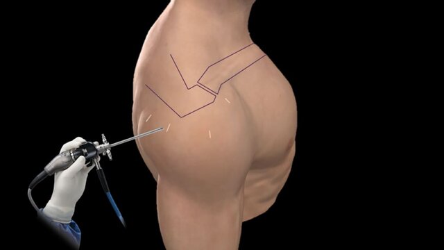 Rotator Cuff Tears: Treatment Options, video thumbnail