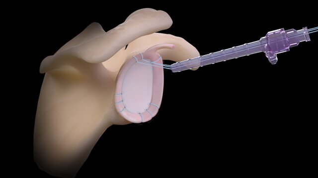 Shoulder Instability: Securing the Ball, video thumbnail