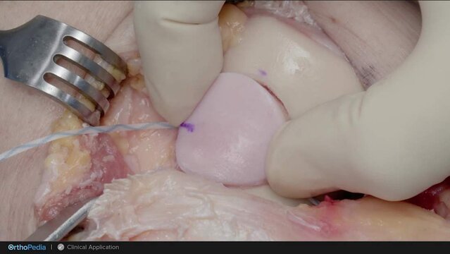 Knee Cartilage Defects: Trochlear Osteochondral Allograft Procedure, video thumbnail