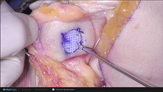 Knee Cartilage Defects: Cartiform® Viable Osteochondral Allograft Procedure for Patella Defects, video thumbnail