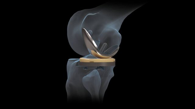 Partial Knee Replacement: Partial Knee Replacement, video thumbnail