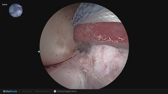 Orthobiologics: QuadLink™ ACL Reconstruction Augmented With BioACL™ Technique, video thumbnail