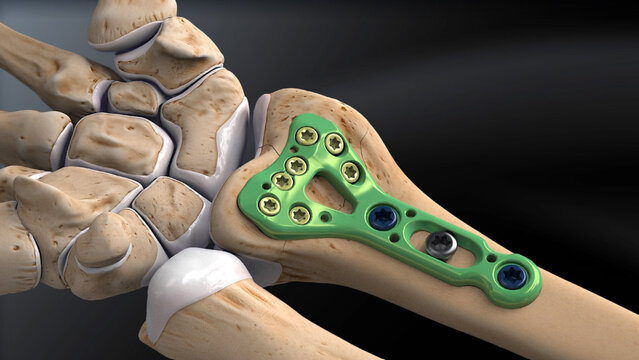 Wrist Fractures: Distal Radius Fracture Repair With a Volar Plate, video thumbnail