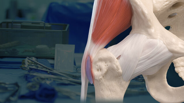 Hip Bursitis: Treatment Options, video thumbnail