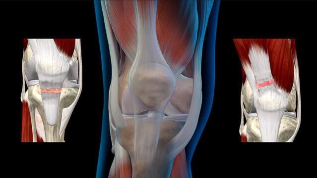 Patellar and Quadriceps Tendon Tears: Overview, video thumbnail