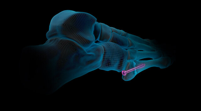 Fifth Metatarsal (Jones) Fractures: Treatment Options, video thumbnail