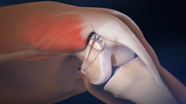 Kneecap (Patellar) Instability: Ligament Reconstruction Using Soft Anchors and Screws, video thumbnail