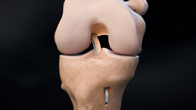ACL Tears: BTB ACL Reconstruction With Tensionable Suture Implant and Absorbable Screw, video thumbnail