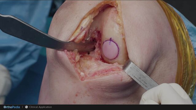 Knee Cartilage Defects: Treatment of a Medial Femoral Condyle Osteochondral Defect Using an Osteochondral Allograft, video thumbnail