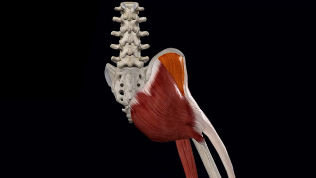 Gluteus Medius Tears: Overview, video thumbnail