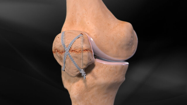 Kneecap (Patella) Fractures: Fixation With Screws and Braided Suture, video thumbnail