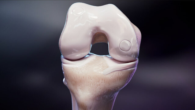 Knee Cartilage Defects: Small Cartilage Defect Replacement, video thumbnail