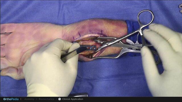 Wrist Fractures: Open Reduction Internal Fixation With Volar Wrist Plating, video thumbnail