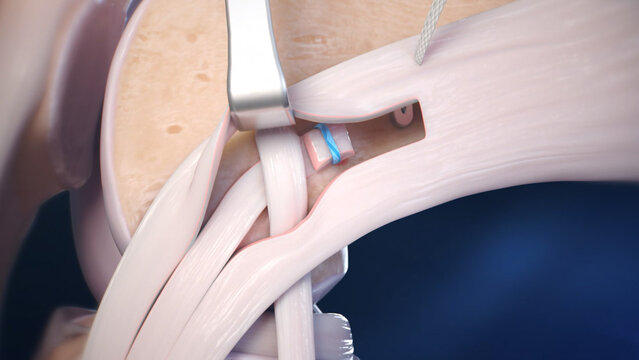 ACL Tears: Lateral Extra-Articular Tenodesis (LET), video thumbnail