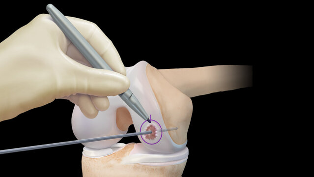Knee Cartilage Defects: Treatment Options, video thumbnail