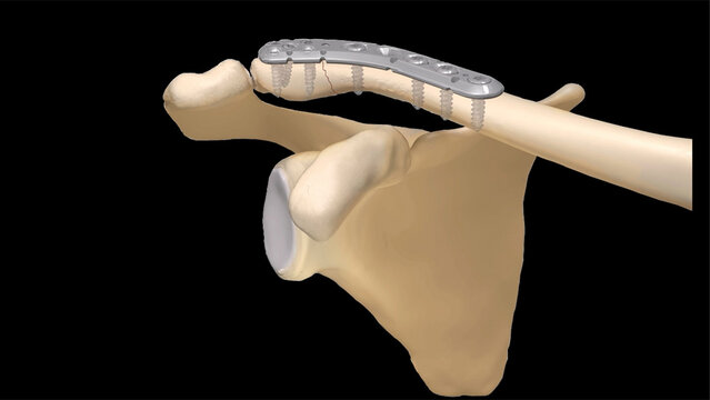 Clavicle Fractures: Treatment Options, video thumbnail