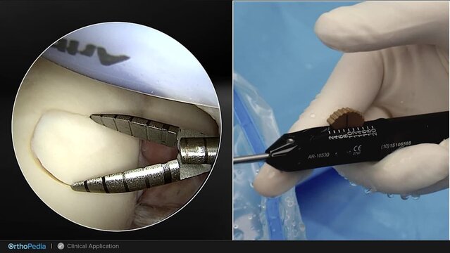 Knee Cartilage Defects: Osteochondral Flap Repair System With Chondral Dart™ Implant, video thumbnail
