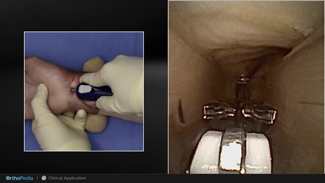 Carpal Tunnel Syndrome: NanoScopic™ Carpal Tunnel Release System, video thumbnail