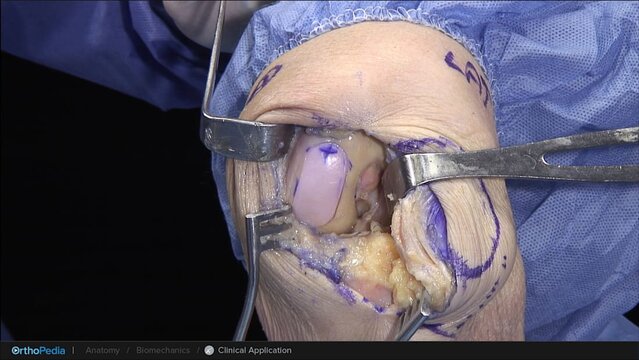Knee Cartilage Defects: Allograft BioUni® OATS® Procedure for Condylar Defects, video thumbnail
