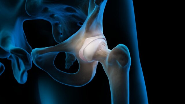 Hip Impingement (FAI) and Labral Tears: Overview, video thumbnail