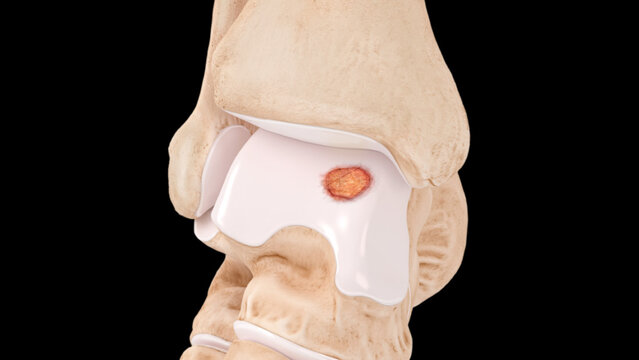 Ankle Cartilage Injuries: Overview, video thumbnail