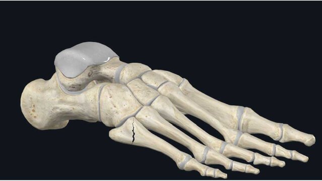 Fifth Metatarsal (Jones) Fractures: Overview, video thumbnail