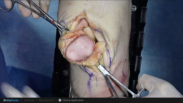 Knee Cartilage Defects: Allograft Resurfacing of the Patella for Patellar Defects, video thumbnail