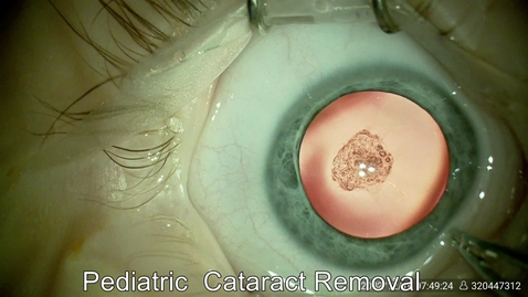 Thumbnail for 202212 Pediatric Cataract surgery w IOL