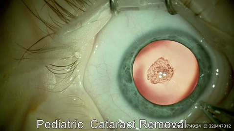 Thumbnail for entry 202212 Pediatric Cataract surgery w IOL