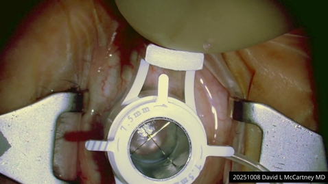 Thumbnail for 2025  PKP with Limbal Skewer