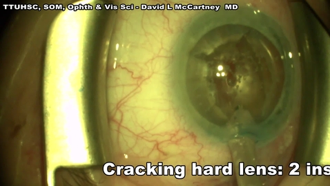Thumbnail for DLM Phaco tools 2inst one incision crack