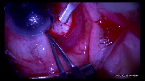 Thumbnail for 20241000 Scleral sut CZ IOL with PKP 8 min std speed
