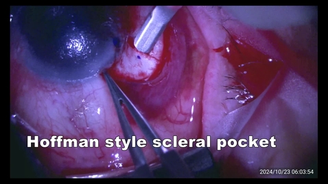 Thumbnail for 20241000 Scleral sut CZ with PKP 8 min std sp