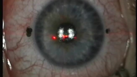 Thumbnail for DLM PRK Allegretto high cyl no MMC