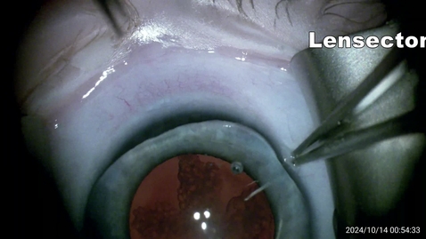 Thumbnail for DLM: 20241101 Lensectomy ant vitrectomy in 10wk AD fam cat
