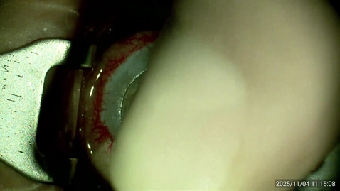 Thumbnail for 20251104 PKP Keratoplasty repeat